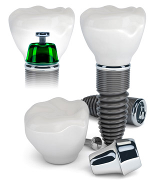 Dental Implants